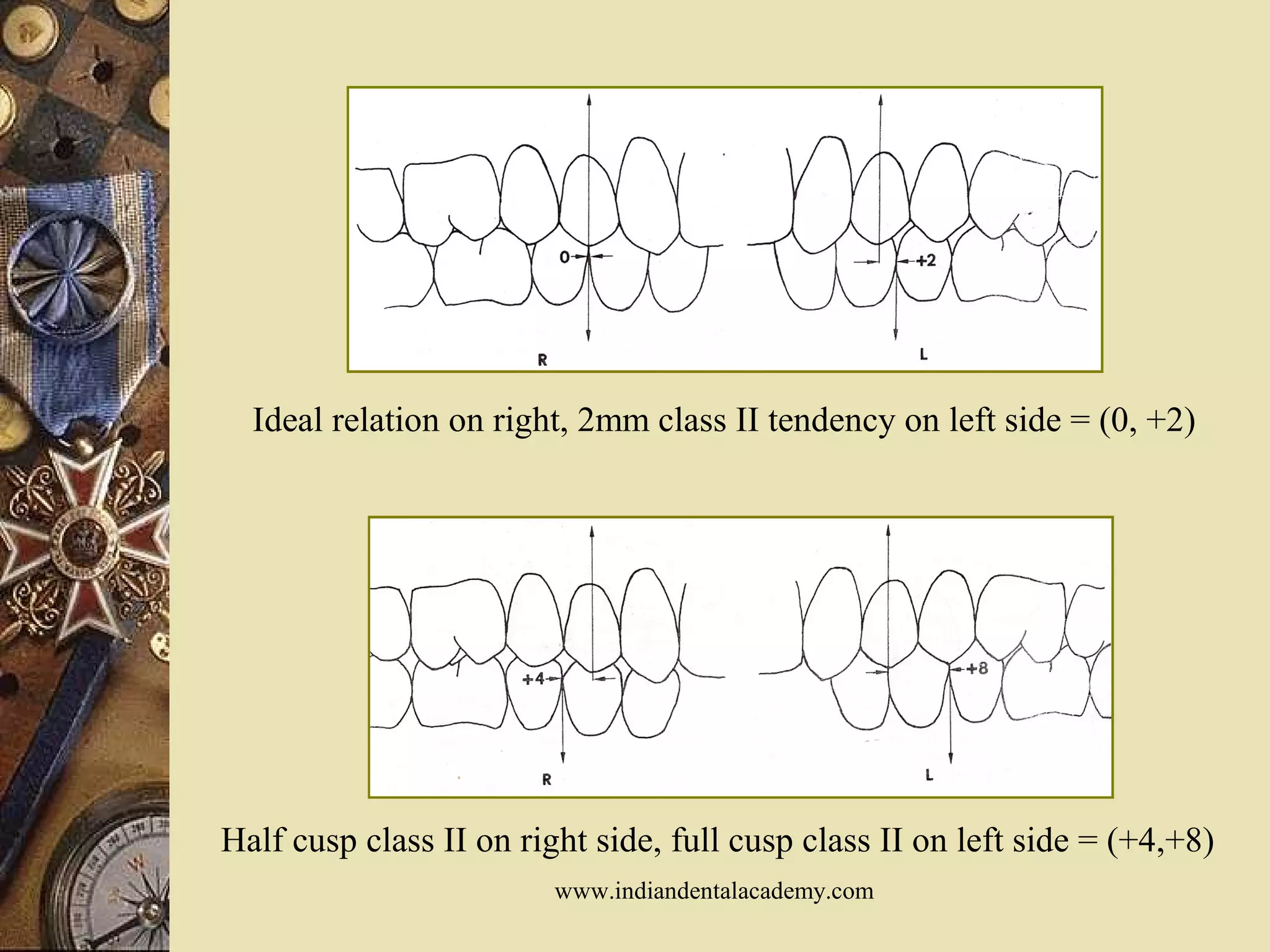 Ideal relation on right, 2mm class II tendency on left side = (0, +2)
Half cusp class II on right side, full cusp class II on left side = (+4,+8)
www.indiandentalacademy.com
 