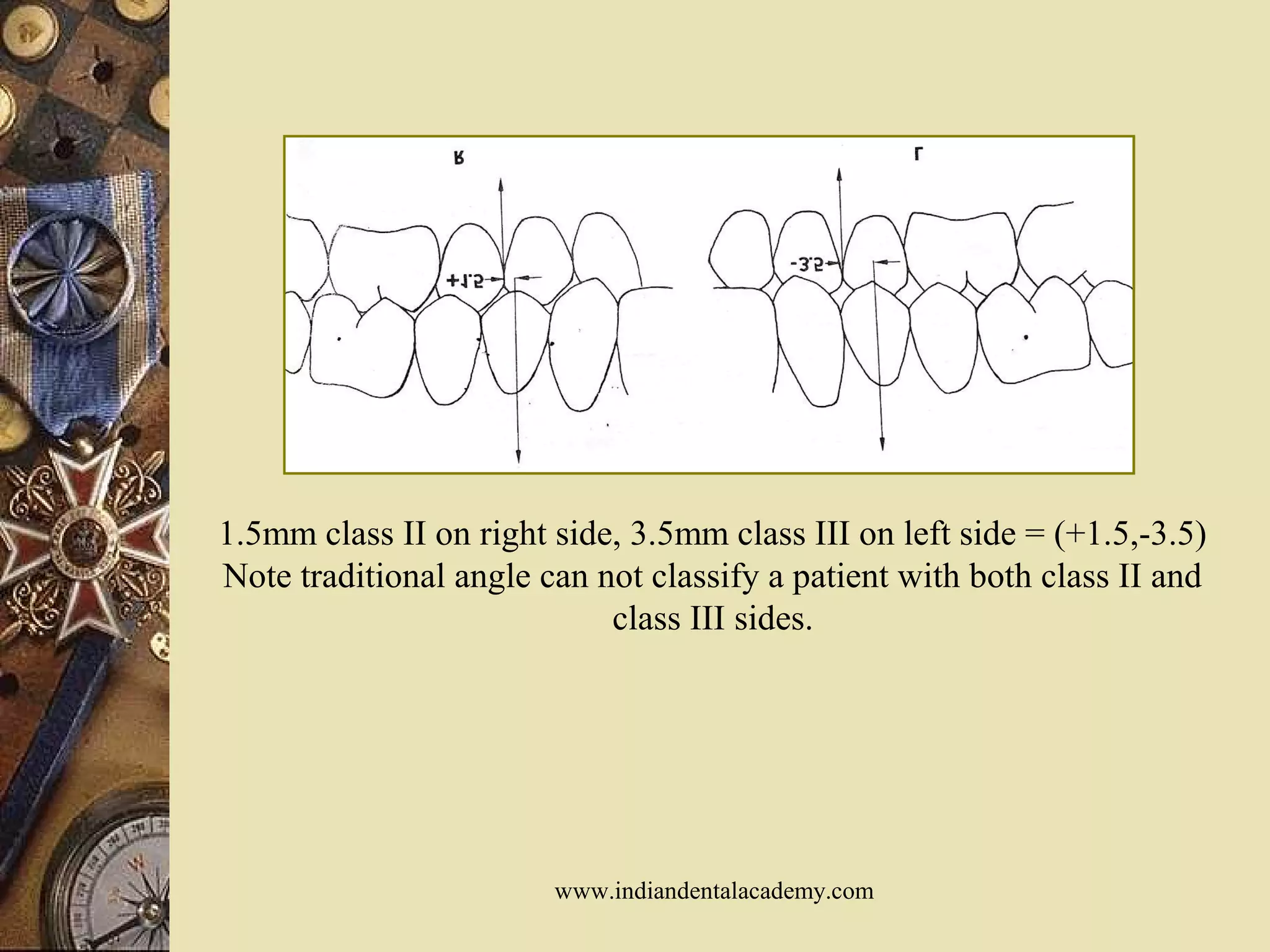 1.5mm class II on right side, 3.5mm class III on left side = (+1.5,-3.5)
Note traditional angle can not classify a patient with both class II and
class III sides.
www.indiandentalacademy.com
 
