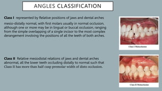 Classification_of_malocclusion[1] [Read-Only].pptx