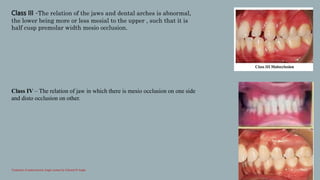 Classification_of_malocclusion[1] [Read-Only].pptx
