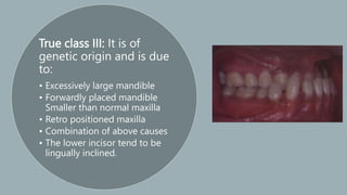 Classification_of_malocclusion[1] [Read-Only].pptx