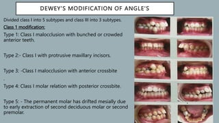 Classification_of_malocclusion[1] [Read-Only].pptx