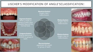 Classification_of_malocclusion[1] [Read-Only].pptx