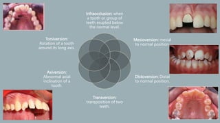 Classification_of_malocclusion[1] [Read-Only].pptx