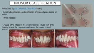 Classification_of_malocclusion[1] [Read-Only].pptx