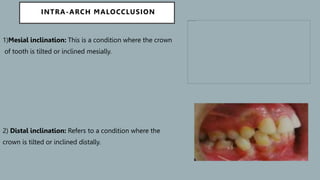 Classification_of_malocclusion[1] [Read-Only].pptx