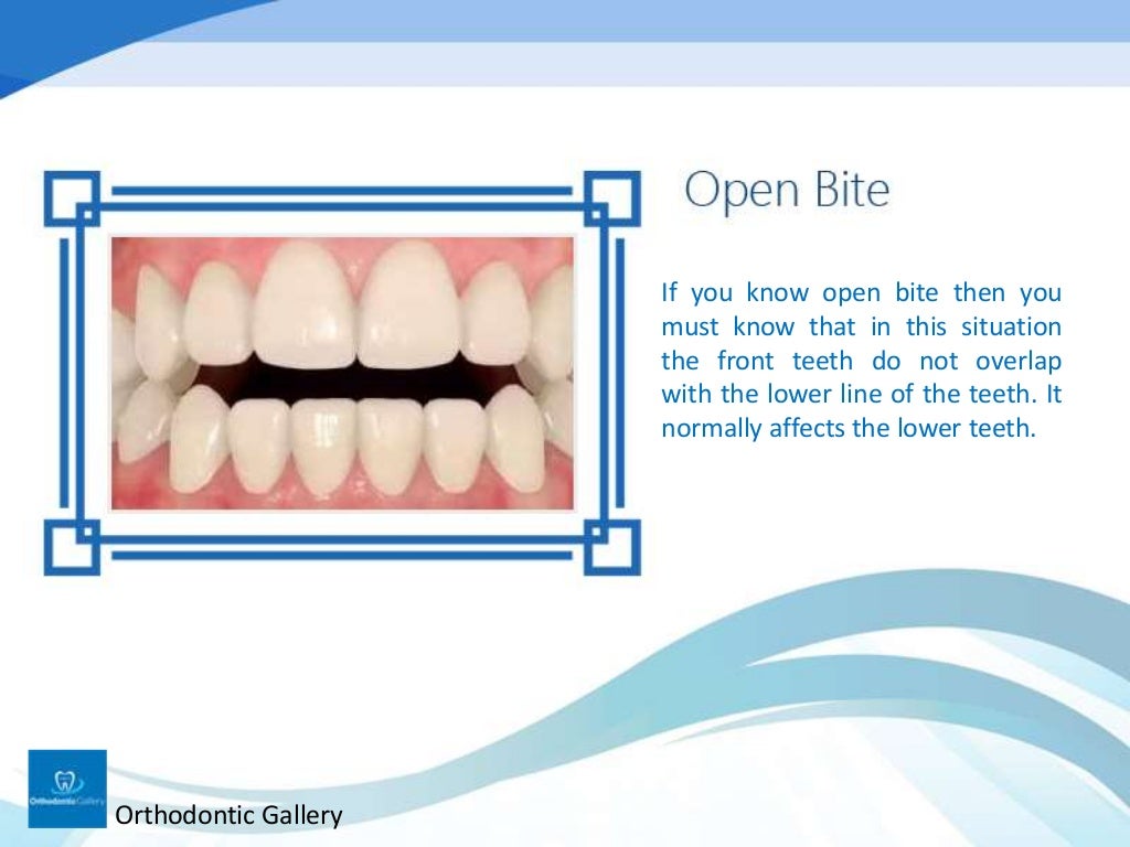 Classification of Malocclusion in Orthodontics