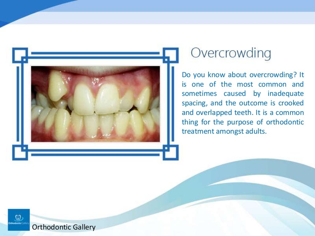 Classification of Malocclusion in Orthodontics