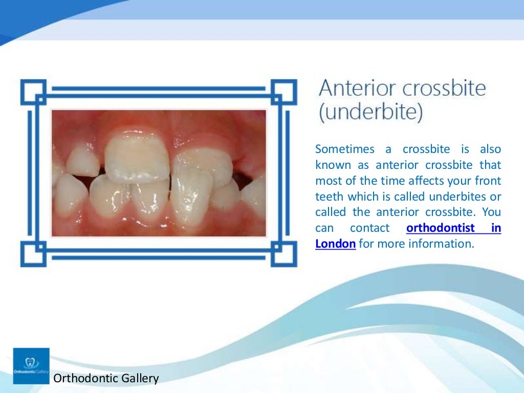 Classification of Malocclusion in Orthodontics