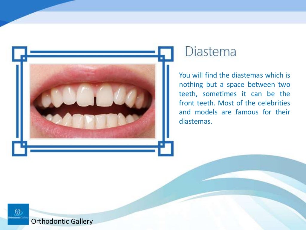 Classification of Malocclusion in Orthodontics