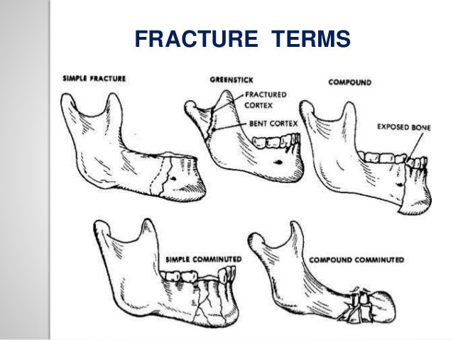 Mandible Fracture Types