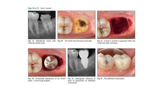 CLASSIFICATION Of molar extraction sites.pptx