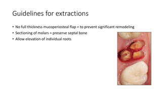 CLASSIFICATION Of molar extraction sites.pptx