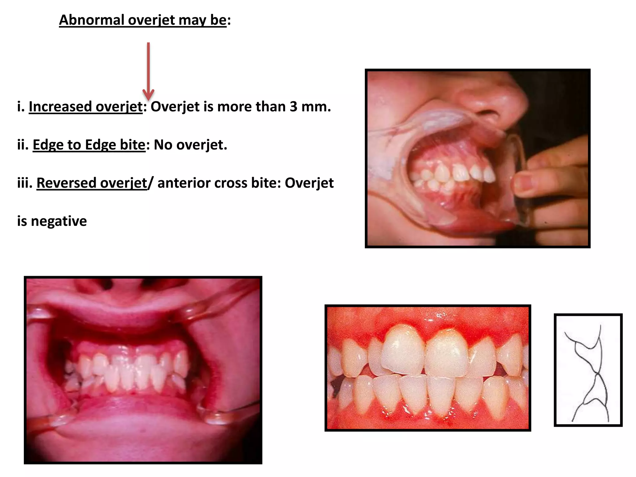 Classification of Occlusion and Malocclusion Dr. Nabil Al-Zubair | PDF