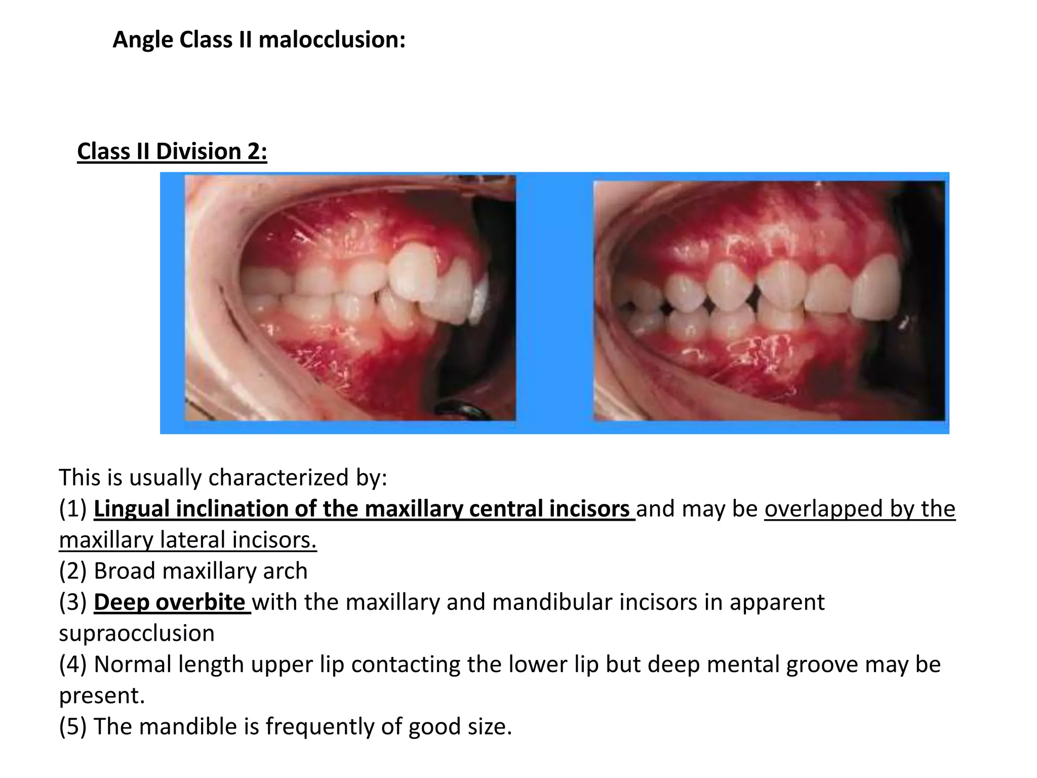 Classification of Occlusion and Malocclusion Dr. Nabil Al-Zubair | PDF