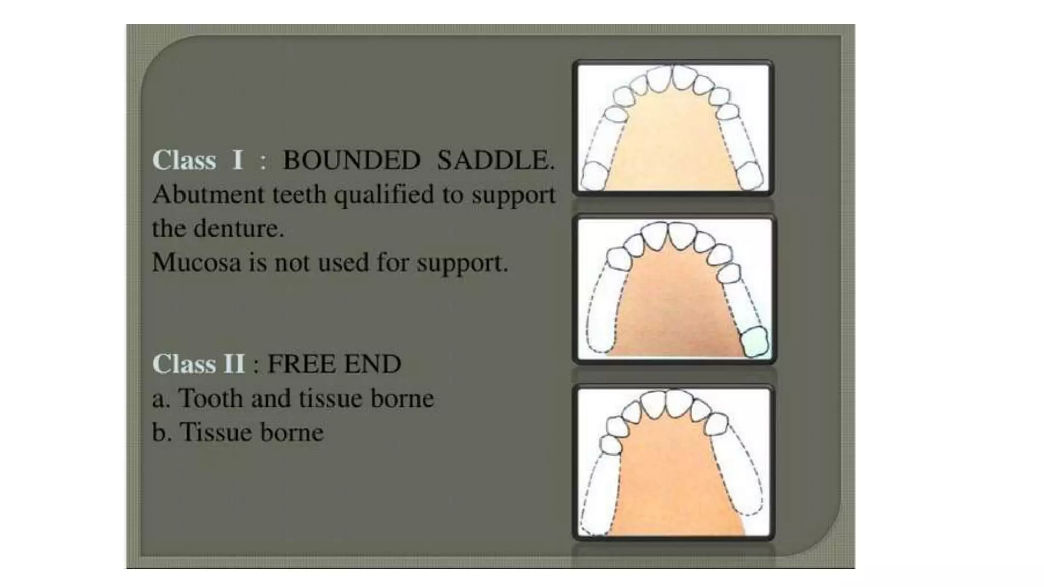 Classification of Partially Edentulous Teeth | PPTX
