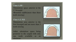 Classification of Partially Edentulous Teeth