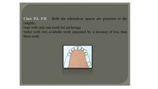 Classification of Partially Edentulous Teeth