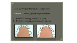 Classification of Partially Edentulous Teeth