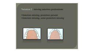 Classification of Partially Edentulous Teeth