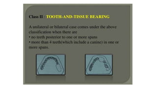 Classification of Partially Edentulous Teeth