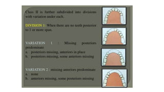 Classification of Partially Edentulous Teeth