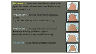 Classification of Partially Edentulous Teeth
