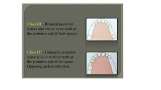 Classification of Partially Edentulous Teeth