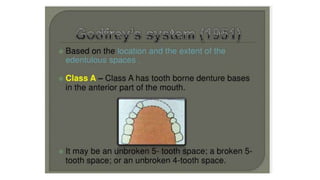 Classification of Partially Edentulous Teeth
