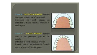 Classification of Partially Edentulous Teeth