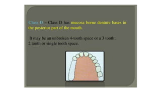 Classification of Partially Edentulous Teeth