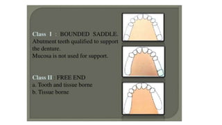 Classification of Partially Edentulous Teeth