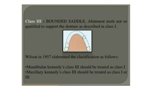 Classification of Partially Edentulous Teeth
