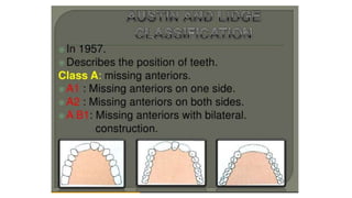 Classification of Partially Edentulous Teeth