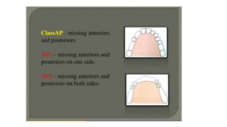 Classification of Partially Edentulous Teeth