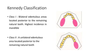 Kennedy Classification
• Class I : Bilateral edentulous areas
located posterior to the remaining
natural teeth. Highest incidence in
mandible
• Class II : A unilateral edentulous
area located posterior to the
remaining natural teeth
 