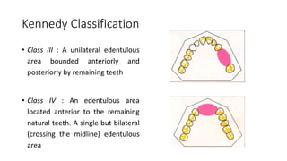 Kennedy Classification
• Class III : A unilateral edentulous
area bounded anteriorly and
posteriorly by remaining teeth
• Class IV : An edentulous area
located anterior to the remaining
natural teeth. A single but bilateral
(crossing the midline) edentulous
area
 