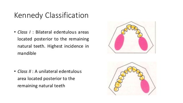 classification of partially edentulous teeth kennedy classification