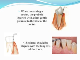 Pocker Instrument Classification of periodontal instruments | PPTX