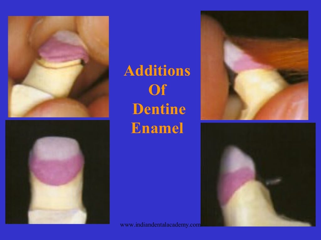 Classification of dental porcelain / dental courses