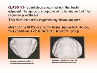 CLASS VI- Edentulous area in which the teeth
adjacent the space are capable of total support of the
required prosthesis.
This denture hardly requires any tissue support.
Most of the RPD’s are tooth tissue supported. Hence,
this condition is classified as a separate group.
Kennedy Applegate’s class V
partially edentulous condition
Kennedy – applegates’ class VI
partially edentulous condition
 