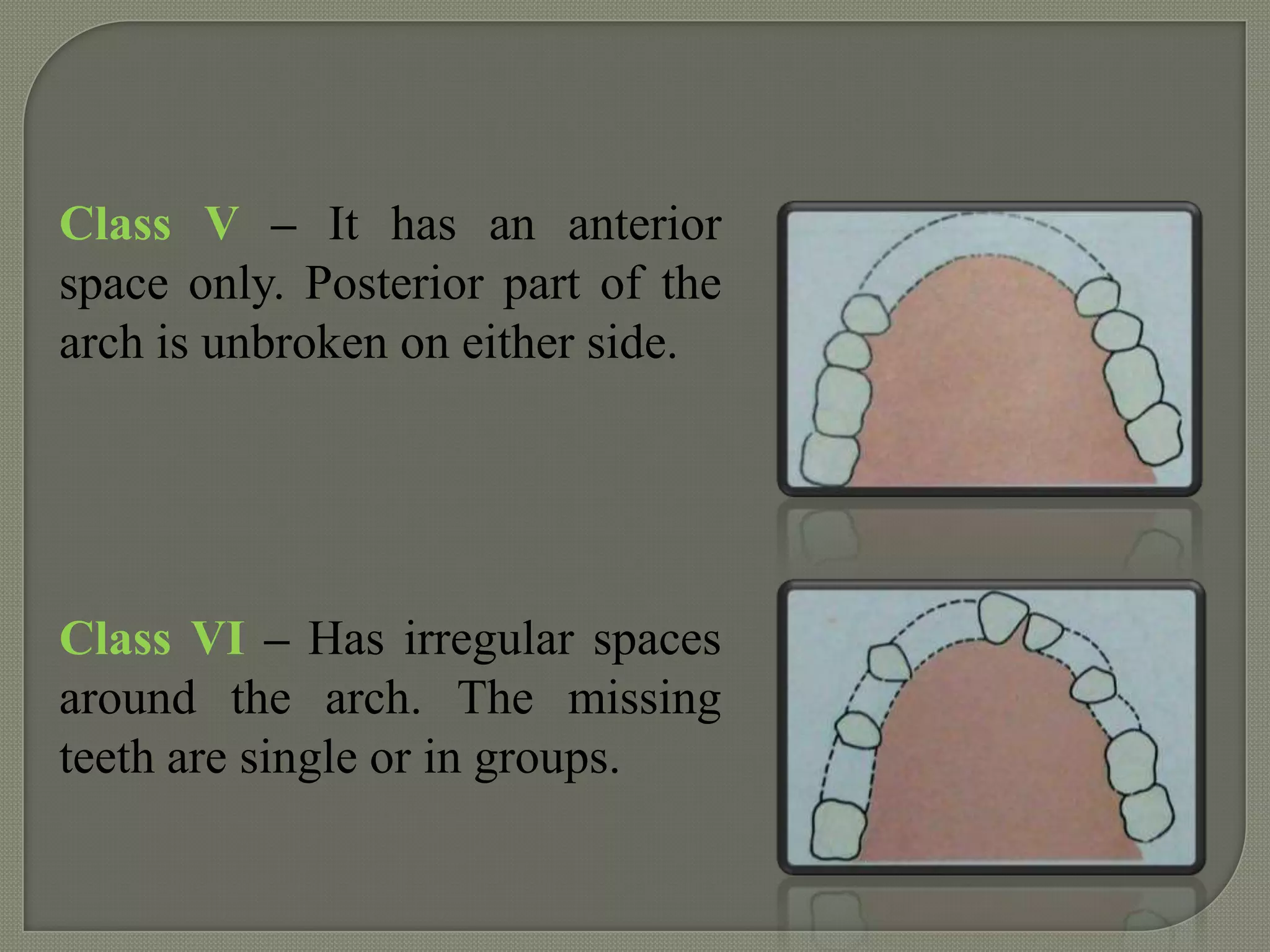 Classification of rpd | PPTX