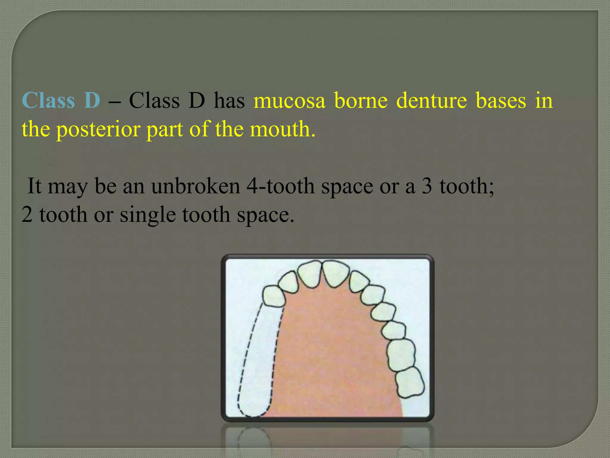 Classification of rpd | PPTX