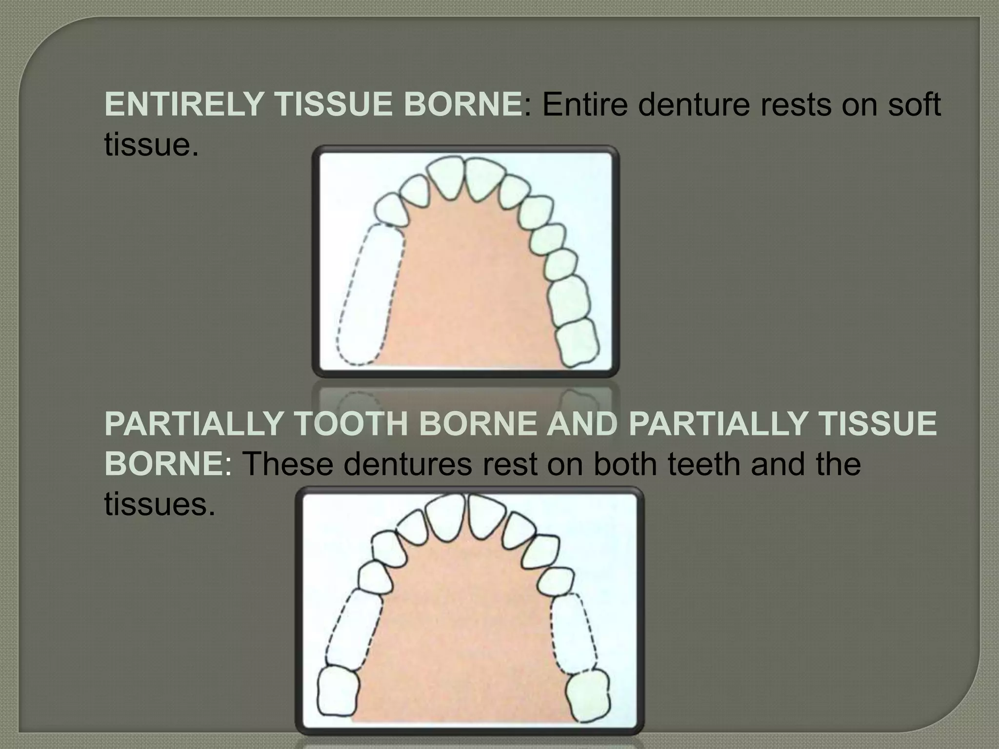Classification of rpd | PPTX
