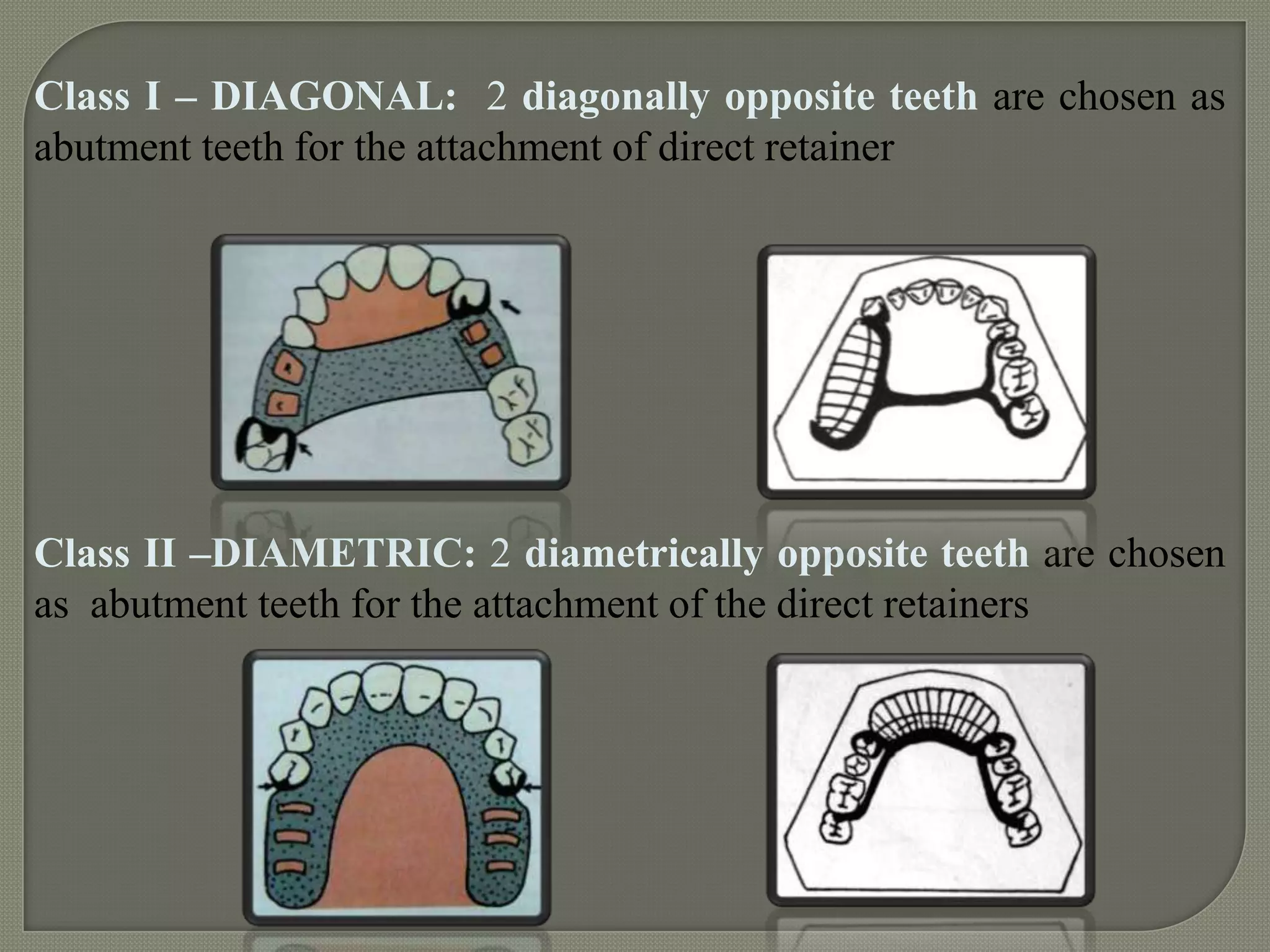 Classification of rpd | PPTX