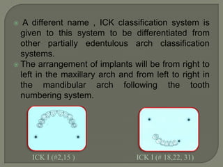 Class IV—Criteria 1Location and extent of edentulous areaSeverely compromisedIt can be extensive and in multiple areas in opposing archesIt does compromise the physiologic support of the abutment teeth to create a guarded prognosisIt includes acquired or congenital maxillofacial defectsAt least one edentulous area has a guarded prognosis