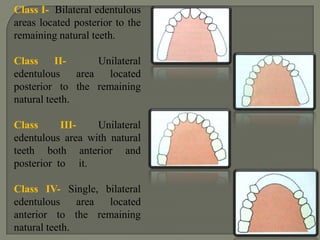 Various classification systemsThere are many classifications available for classifying edentulous arches. The most common ones are:CummerKennedy’sApplegate-KennedyBailynNeurohrMaukFriedman GodfreySkinner Austin and LidgeCraddockWildWatt et alCosta Osborne and LammieBeckettSwenson ACP classification    ICK classification