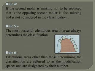  Kennedy’s classification:Most widely used method of classificationProposed in 1923 by Dr. Edward Kennedy of New York. It is based on the relationship of the edentulous spaces to the abutment teeth.