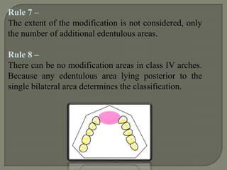 Class I-  Bilateral edentulous areas located posterior to the remaining natural teeth.Class II-  Unilateral edentulous area located posterior to the remaining natural teeth.Class III- Unilateral edentulous area with natural teeth both anterior and posterior  to     it.Class IV- Single, bilateral edentulous area located anterior to the remaining natural teeth.
