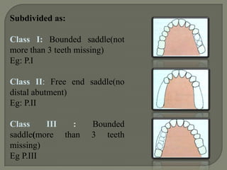 DR. O.C APPLEGATE (1960) later attempted to expand the kennedy system by adding class V and VI.Class V:   Edentulous area bounded anteriorly and posteriorly by the natural teeth but in which the anterior abutment  (the lateral incisor) is not suitable for the support.Class VI:  an edentulous situation in which the teeth adjacent to the space are capable of total support of the required prosthesis